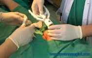 Phòng khám Đa khoa Hoàn Cầu tổng quan các phương pháp cắt bao quy đầu
