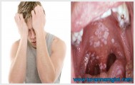 Triệu chứng bệnh lậu ở nam giới điển hình dễ nhận ra nhất