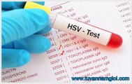 [TP.HCM] Xét nghiệm HSV là gì và địa chỉ nào uy tín để an tâm xét nghiệm?