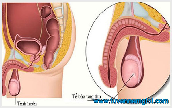 Người bệnh viêm tinh hoàn cần chú ý thay đổi thói quen sinh hoạt